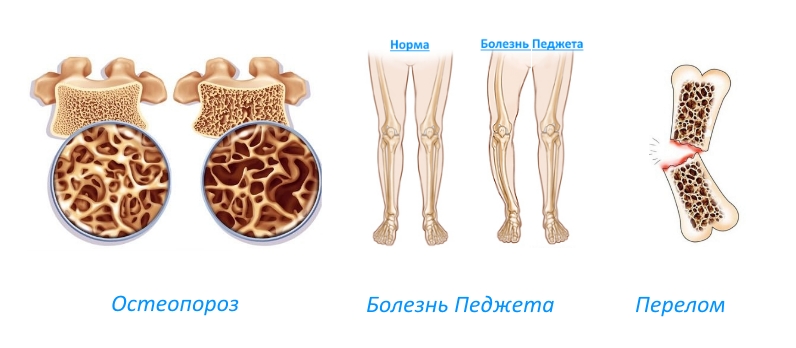 Показания для приема препарата Фосамакс