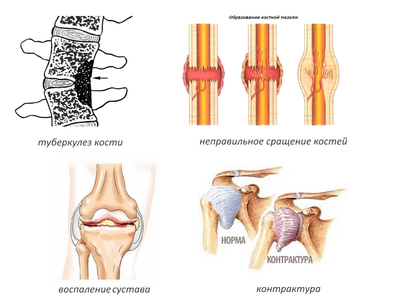 Показания для артролиза