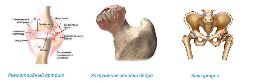 Показания для эндопротезирвоания тазобедренного сустава