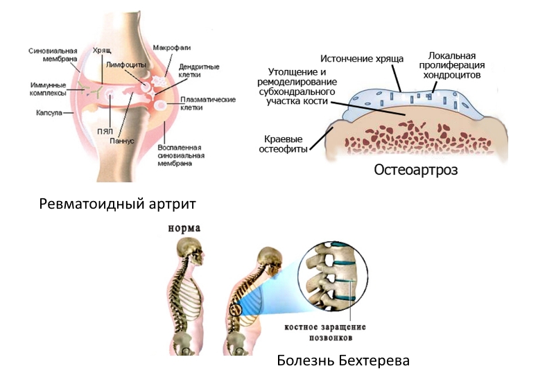 Показания для Артрозана
