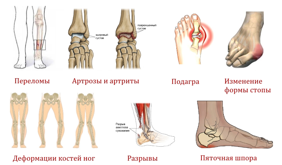 Показания для рентгена ног