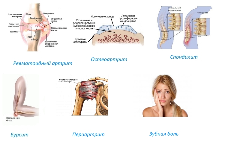 Показания к Ацеклофенаку