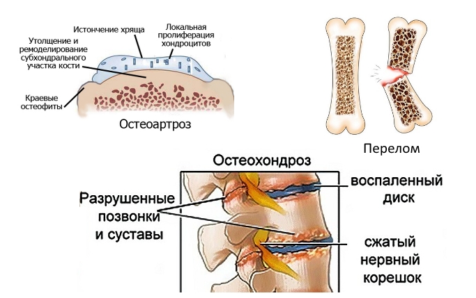 Показания к Хондрогарду