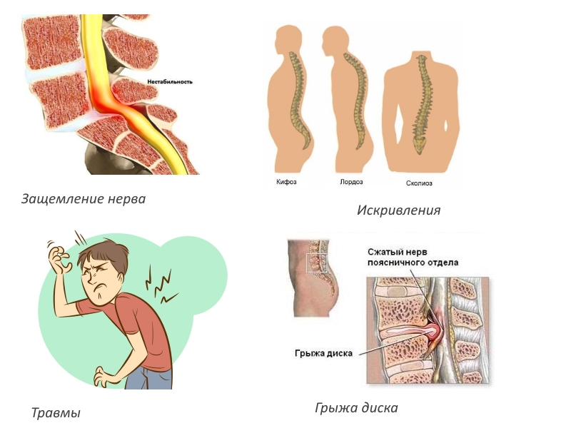 Показания к вытяжению позвоночника