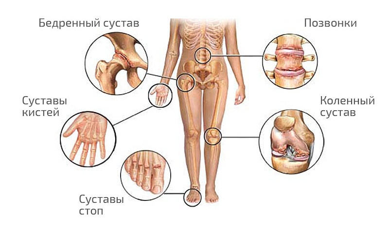 Развитие полиартрита как осложнение