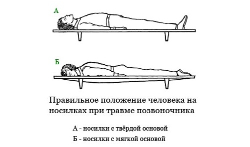 Положение на носилках при ушибе позвоночника