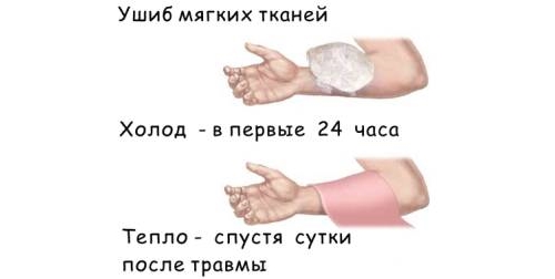 Помощь при ушибе мягких тканей