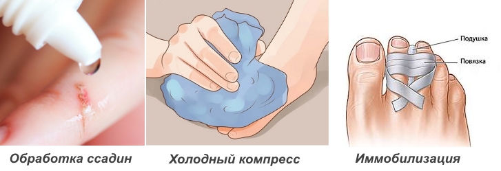 Первая помощь при ушибе пальца на ноге