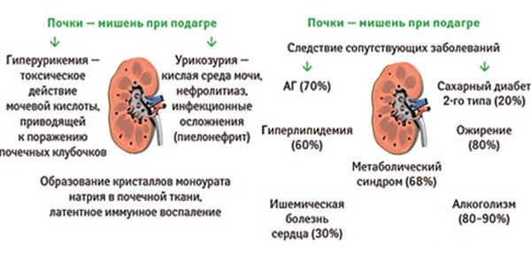 Поражение почек при подагре