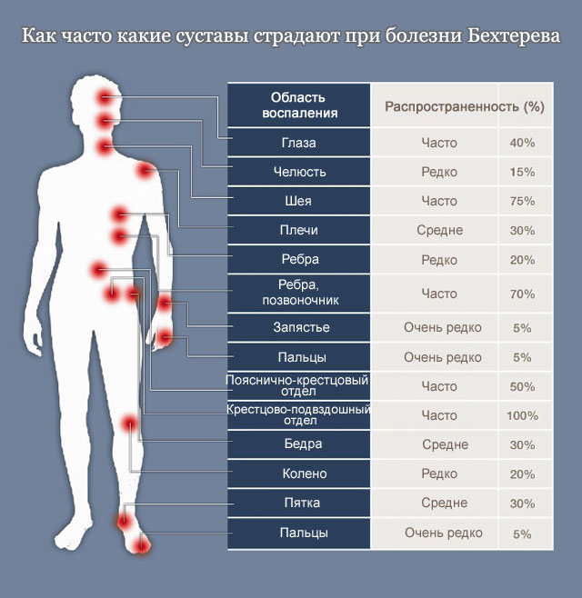 Поражение суставов при болезни бехтерева