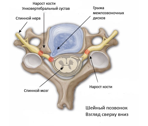 Поражение унковертебрального сустава