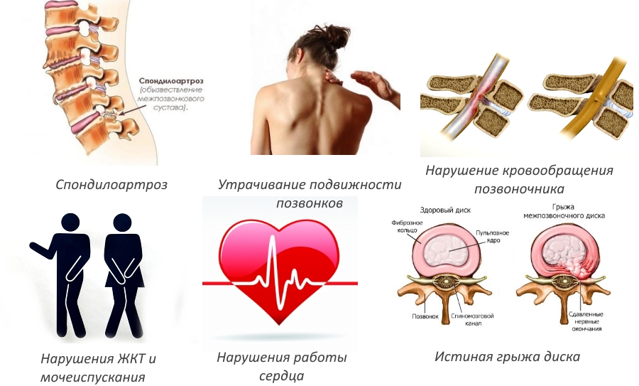 Последствия грыжи Шморля