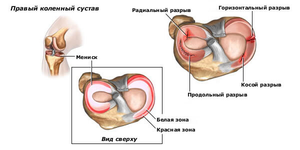 Менископатия - повреждение менисков колена