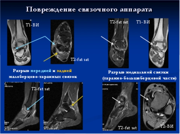 Повреждение связки голеностопа на МРТ