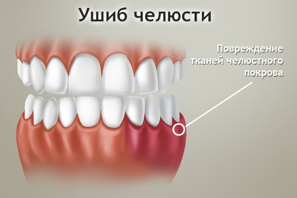 Повреждение тканей челюсти