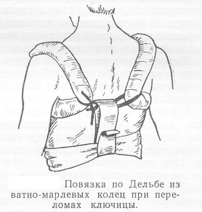 Перевязка Дельбе