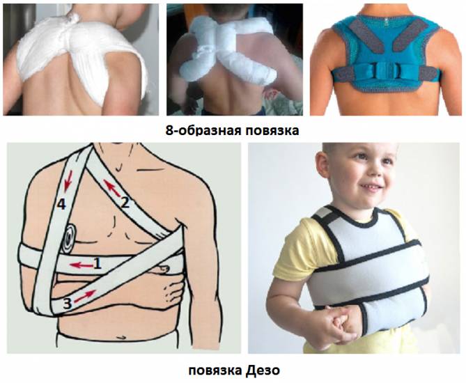Повязки для ключицы