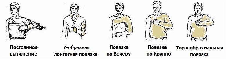 Повязки при переломах плеча