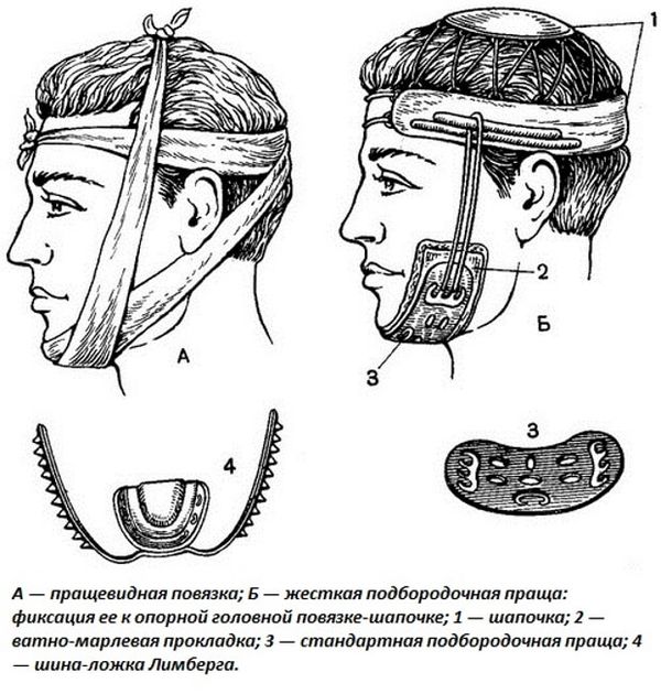 Повязки при переломе челюсти