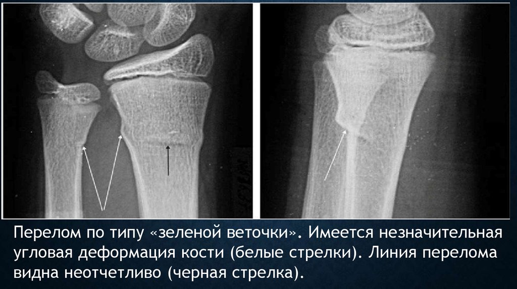 Перелом по типу зеленой ветки на рентген снимке