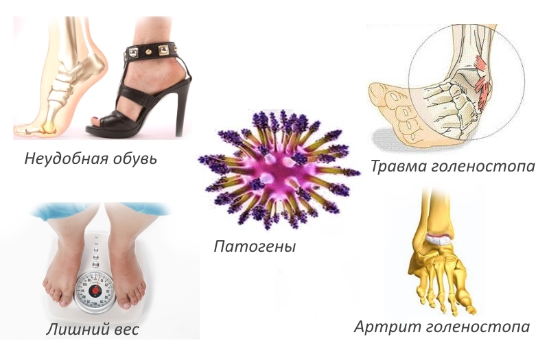 Причины ахиллобурсита