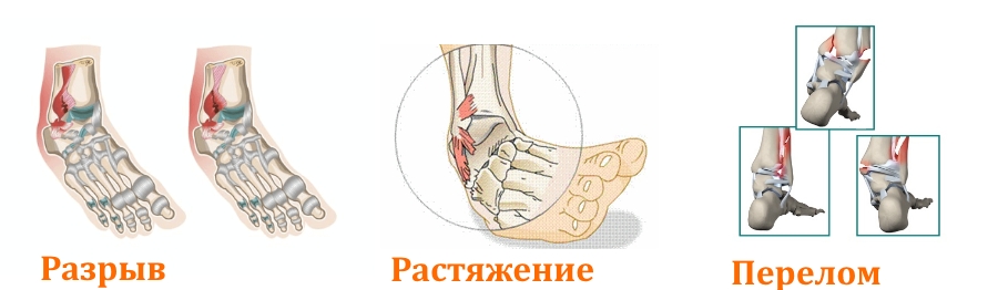 Травмы щиколотки