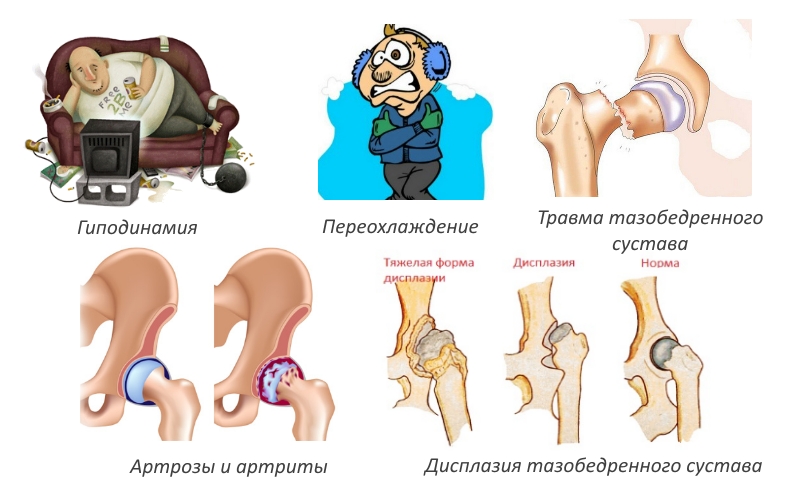 Причины бурсита тазобедренного сустава
