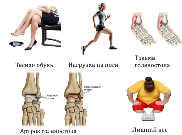 Частые причины кисты голеностопа