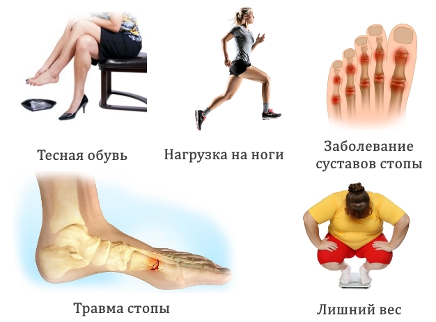 Причины гигромы стопы