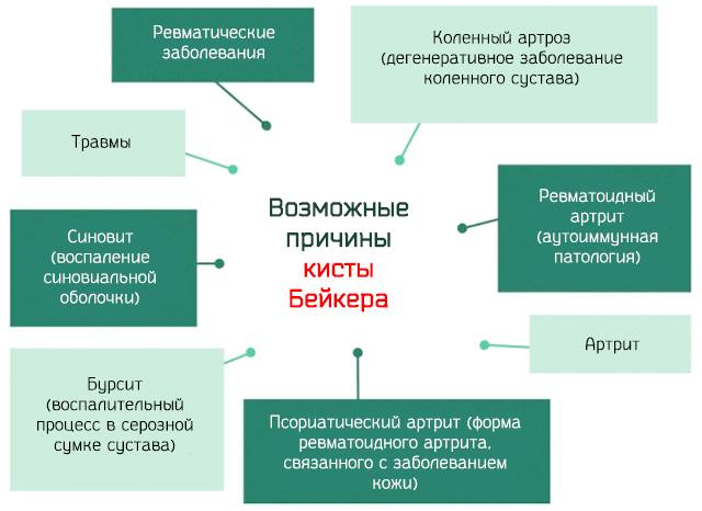 Причины кисты Бейкера