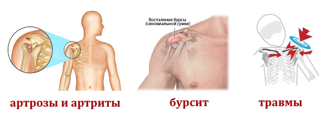 Причины кисты плечевого сустава