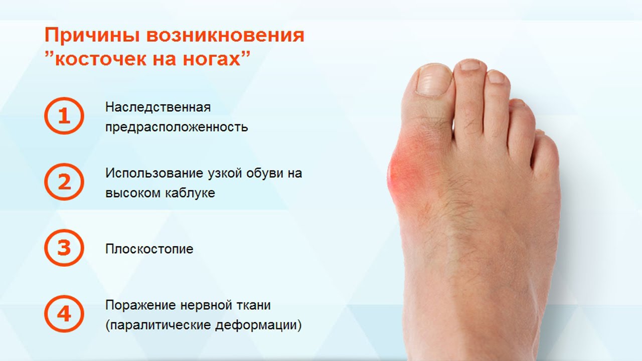 Причины косточки на ноге