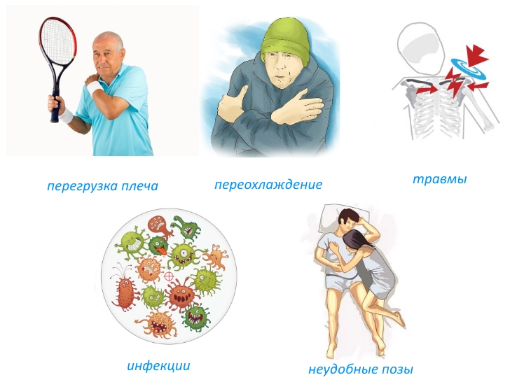 Причины миозита плеча