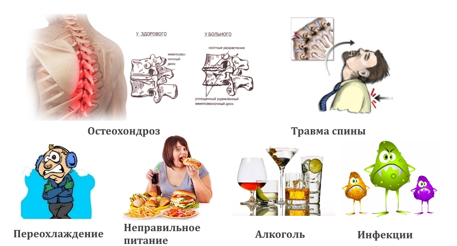 Частые причины невралгии