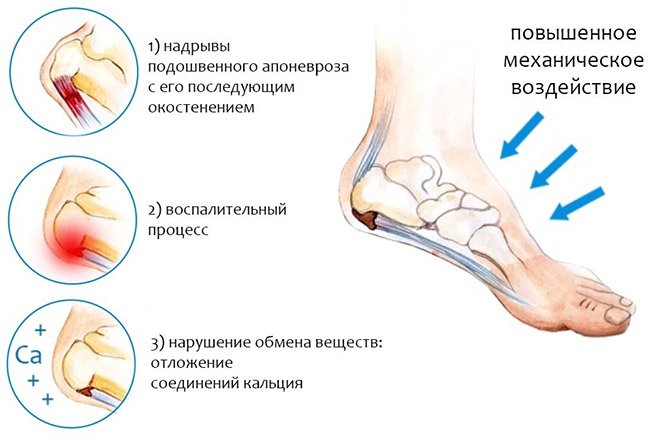 Причины плантарного фасциита