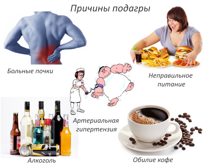 Причины подагры