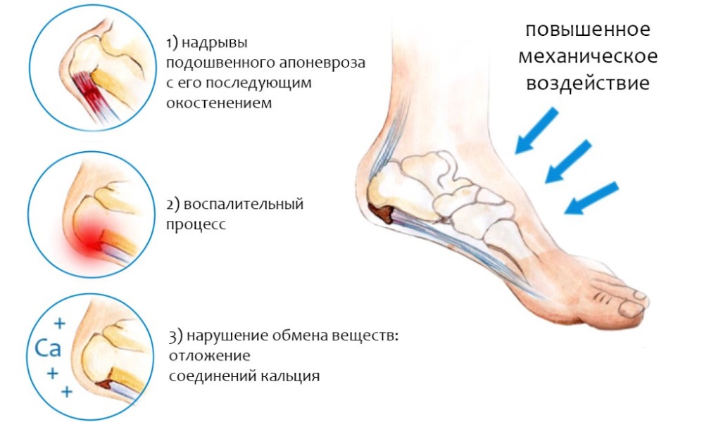 Причины пяточной шпоры