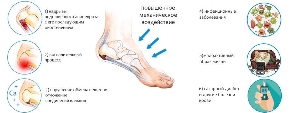 Причины пяточной шпоры