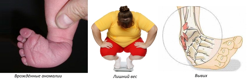 Частые причины вальгусной деформации