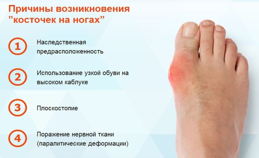 Причины возникновения косточки на ноге