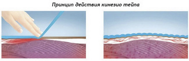 Принцип действия кинезио тейпа
