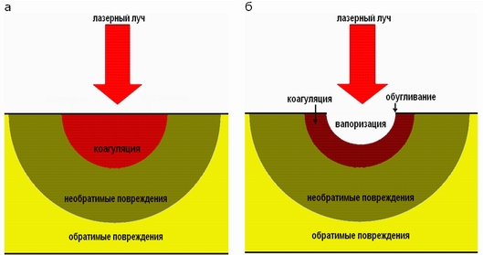 Принцип действия лазерного лечения