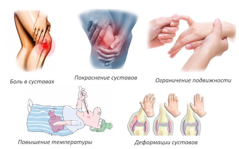 Признаки артрита суставов