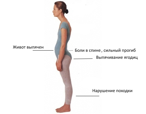 Признаки лордоза