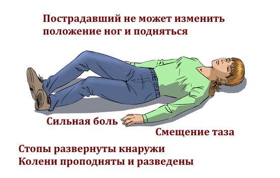 Признаки перелома костей таза