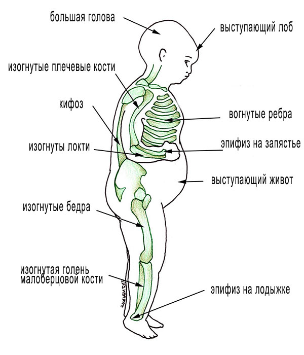 Признаки рахита