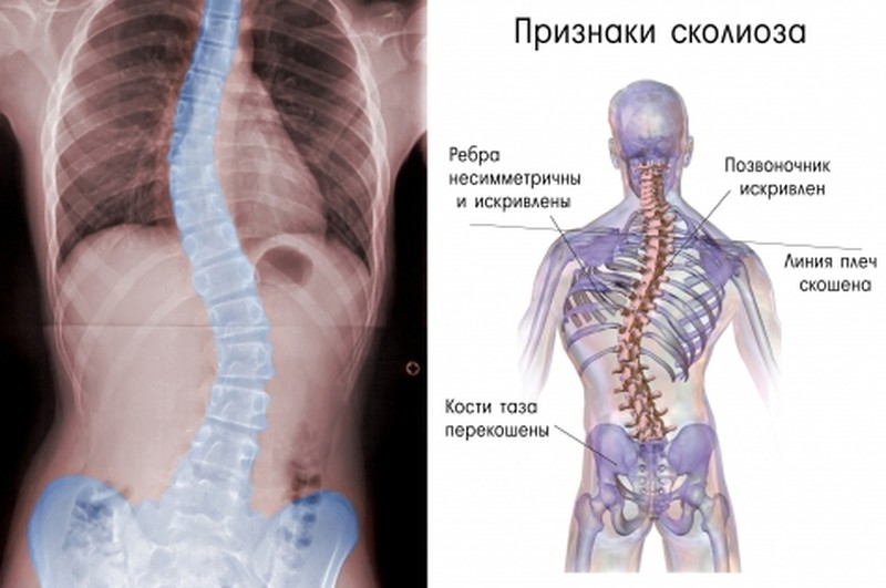 Признаки сколиоза позвоночника