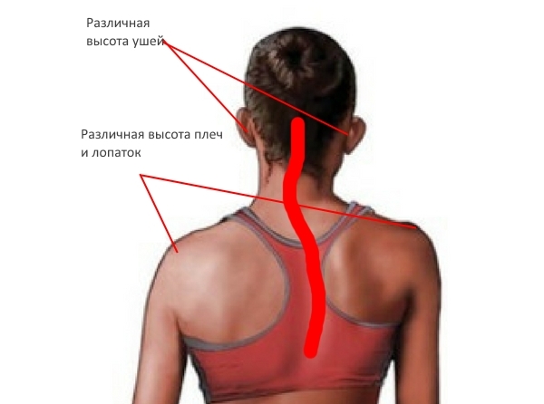 Признаки сколиоза шеи