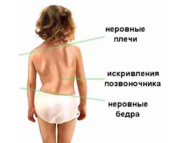 Признаки сколиоза
