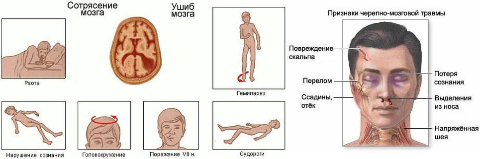 Признаки сотрясения головного мозга